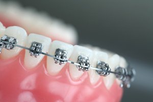  ارتودنسی باعث تحلیل ریشه دندان می شود