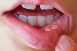 آفت های دهانی خود را با شیرنارگیل درمان کنید