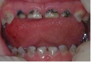 پوسیدگی دندان و پیشگیری از پوسیدگی دندان-1