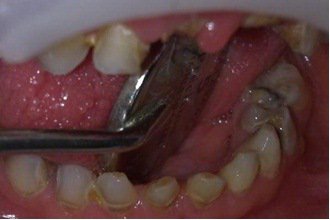 پوسیدگی دندان و پیشگیری از پوسیدگی دندان-3