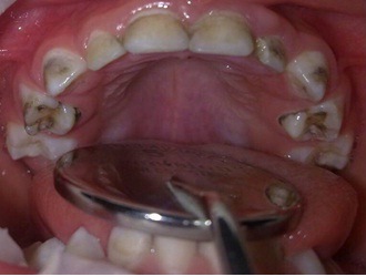 پوسیدگی دندان و پیشگیری از پوسیدگی دندان-4