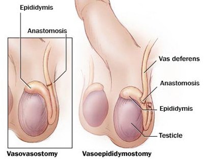 vasectomy-reversal-surgery.jpg