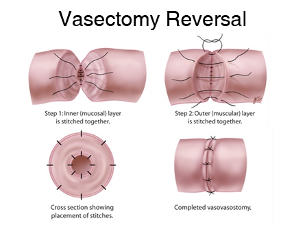 vasectomy-reversal.jpg